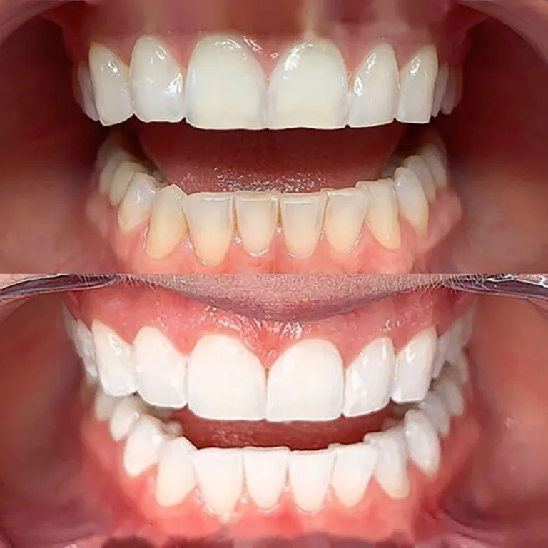 1-Teeth-Whitening-768x768