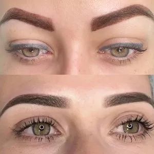 Brow Correction NYC And NJ