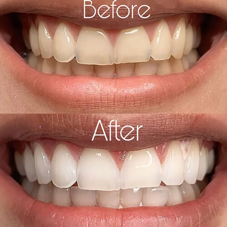 2-Teeth-Whitening-768x768