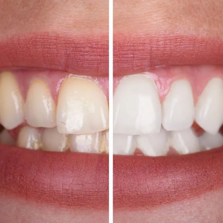 4-Teeth-Whitening-768x768