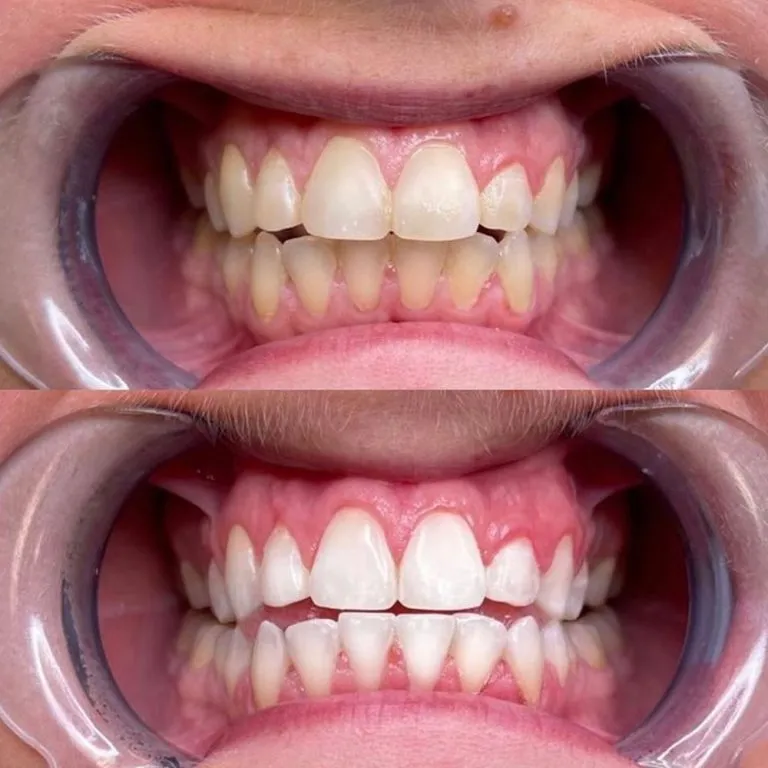 5-Teeth-Whitening-768x768