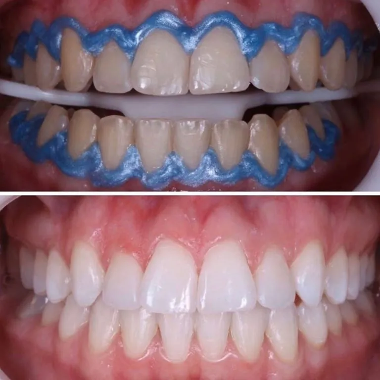 6-Teeth-Whitening-768x768