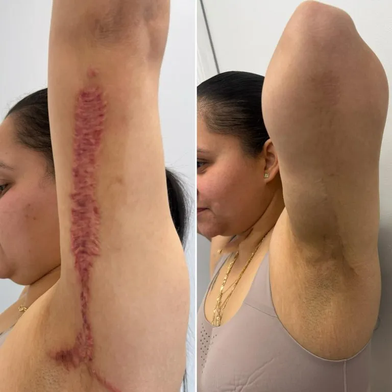 BENEFITS-OF-SCAR-CAMOUFLAGE-768x768