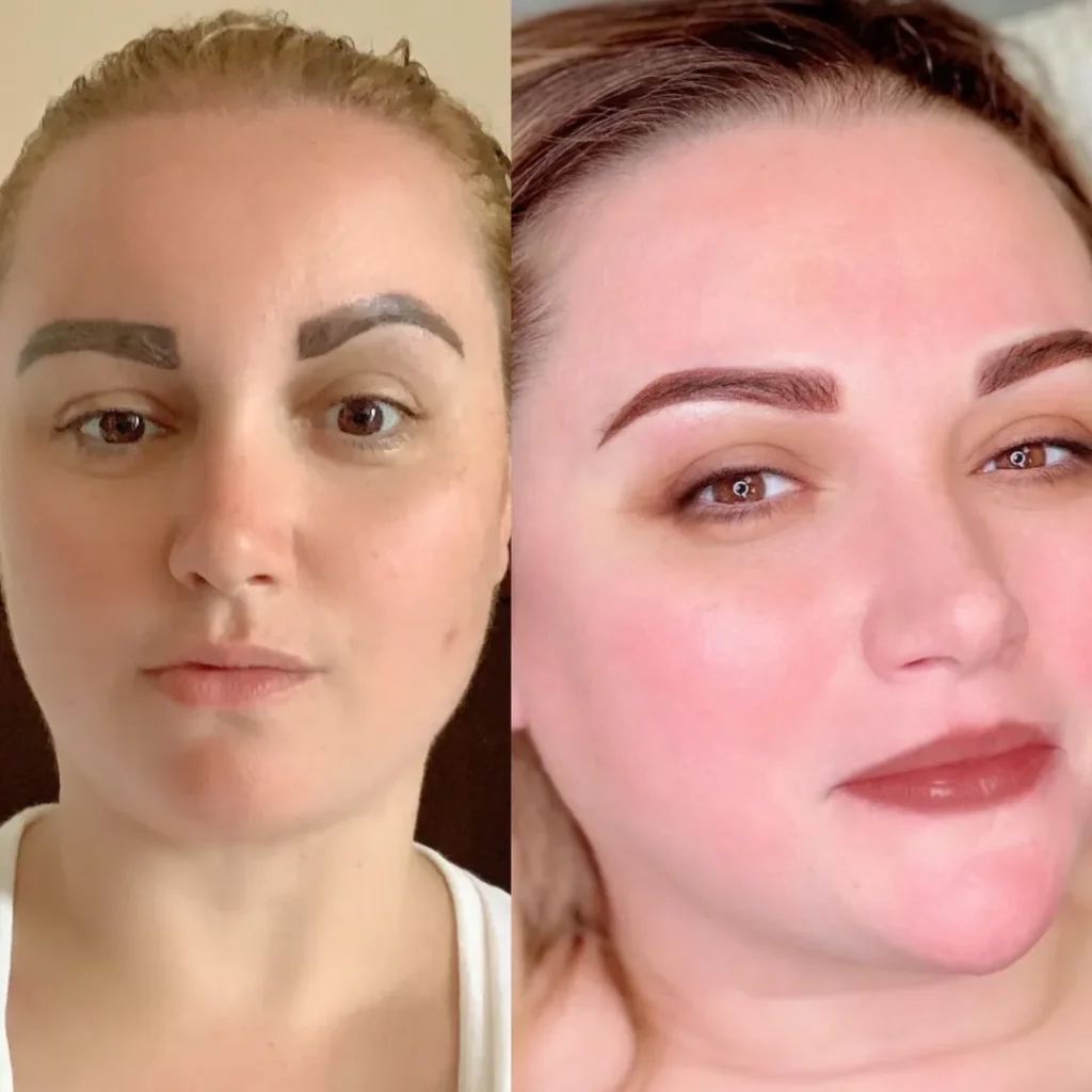 Brow Correction NYC And NJ
