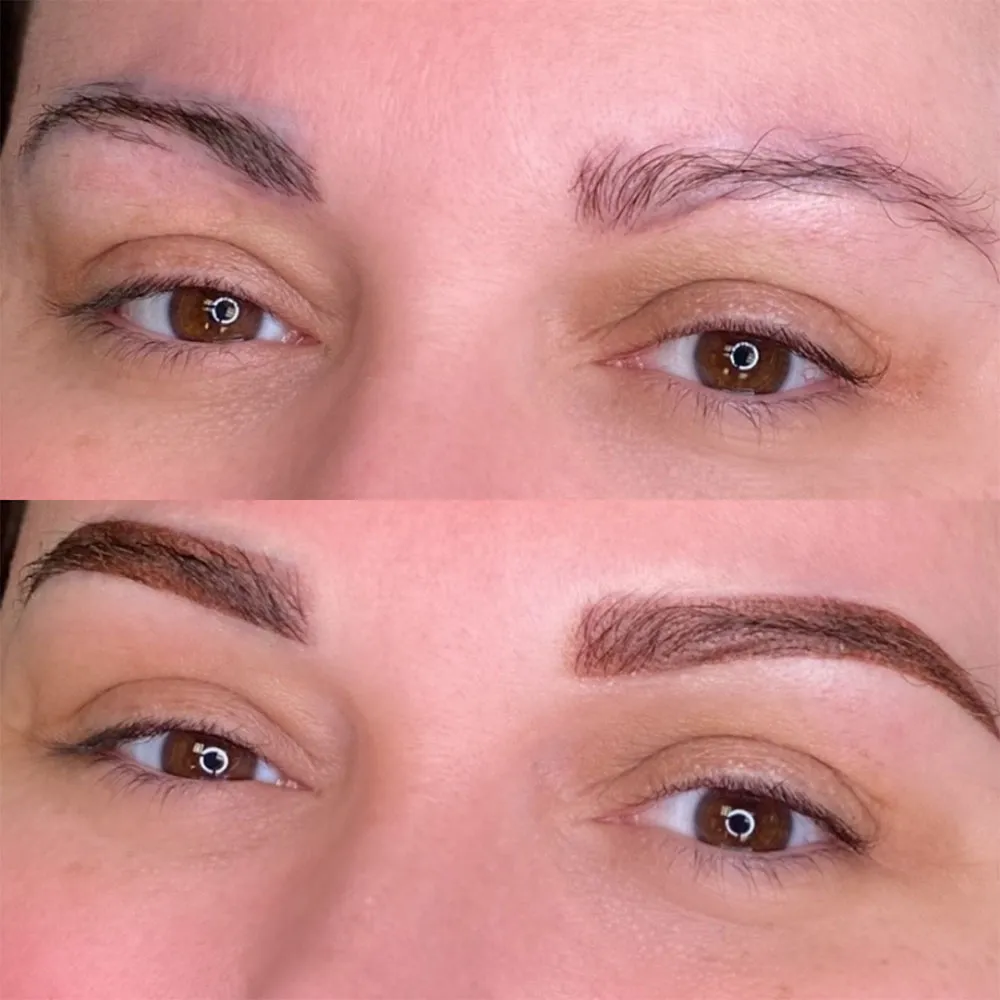 Brow Correction NYC And NJ