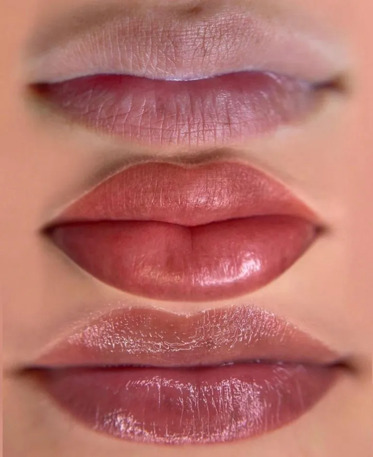 Lip-Correction-2-768x940