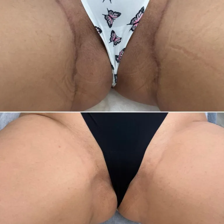 SCAR-AND-STRETCH-MARK-CAMOUFLAGE-768x768