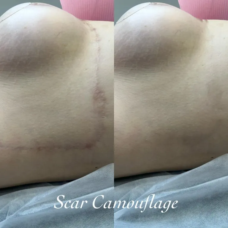 SCAR-STRETCH-MARK-CAMOUFLAGE-1-1-768x768