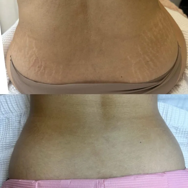 SCAR-STRETCH-MARK-CAMOUFLAGE-1-768x768