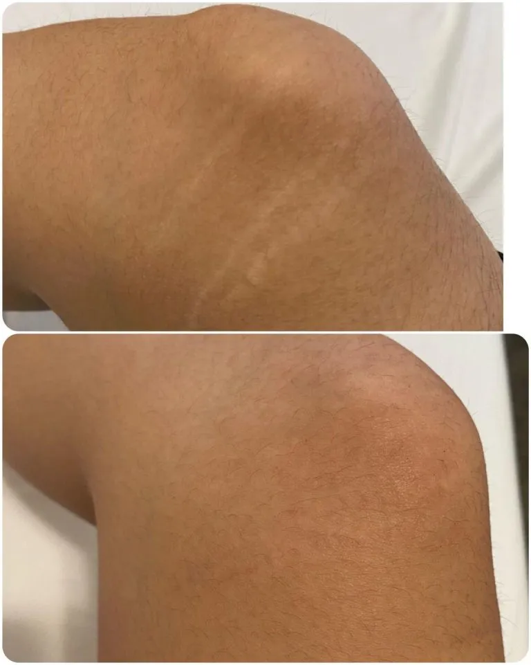 SCAR-STRETCH-MARK-CAMOUFLAGE-1-768x961