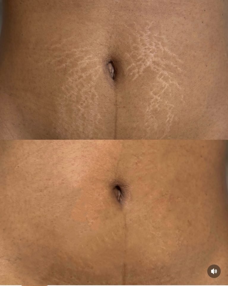 SCAR-STRETCH-MARK-CAMOUFLAGE-1-768x962