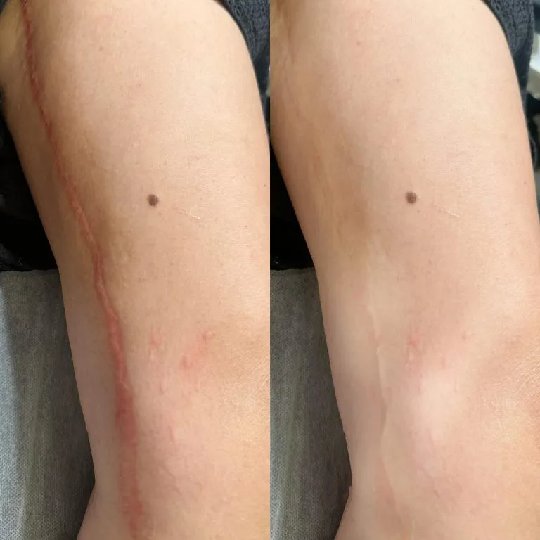 SCAR-STRETCH-MARK-CAMOUFLAGE-2-768x768 (1)