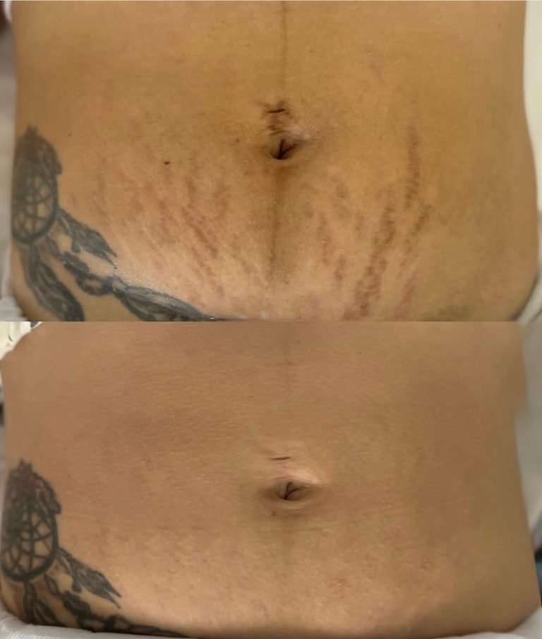 SCAR-STRETCH-MARK-CAMOUFLAGE-2-768x905