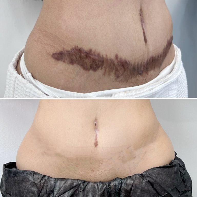 SCAR-STRETCH-MARK-CAMOUFLAGE-3-768x768