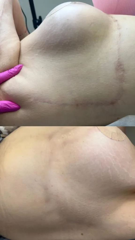 SCAR-STRETCH-MARK-CAMOUFLAGE-576x1024