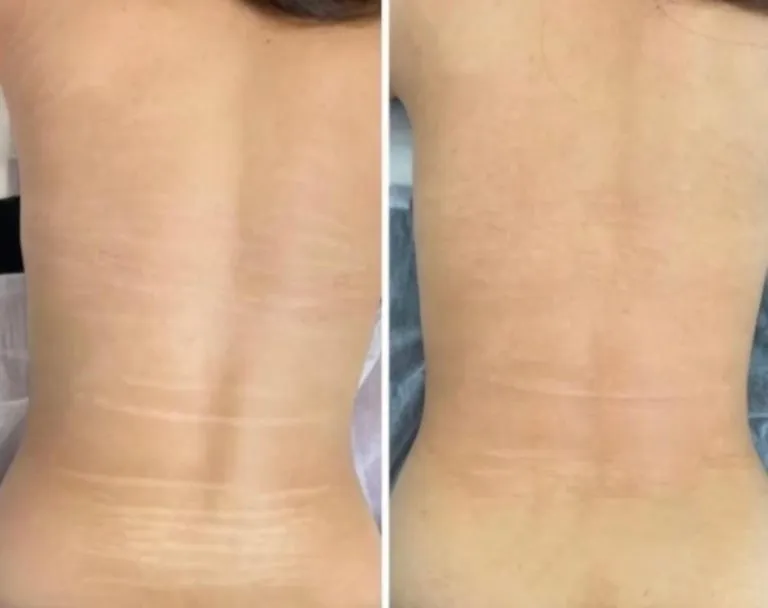 SCAR-STRETCH-MARK-CAMOUFLAGE-768x608