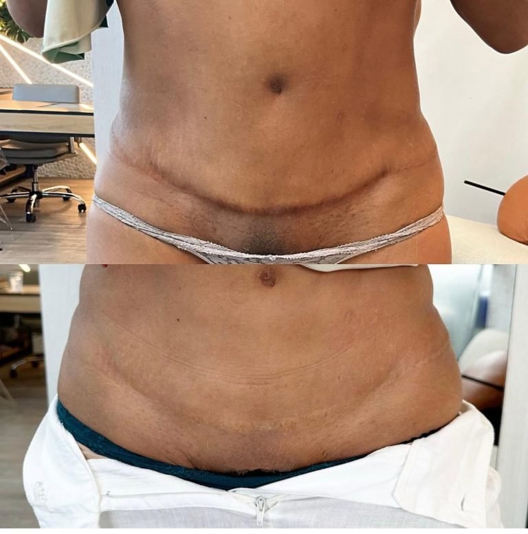 SCAR-STRETCH-MARK-CAMOUFLAGE-768x776