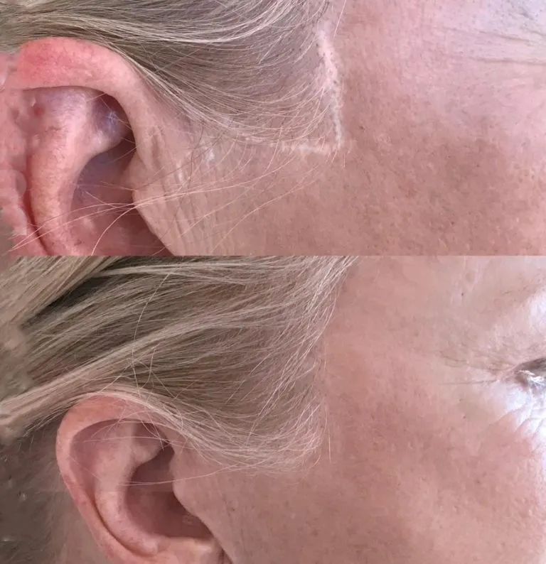 SCAR-STRETCH-MARK-CAMOUFLAGE-GALLERY-4-768x794