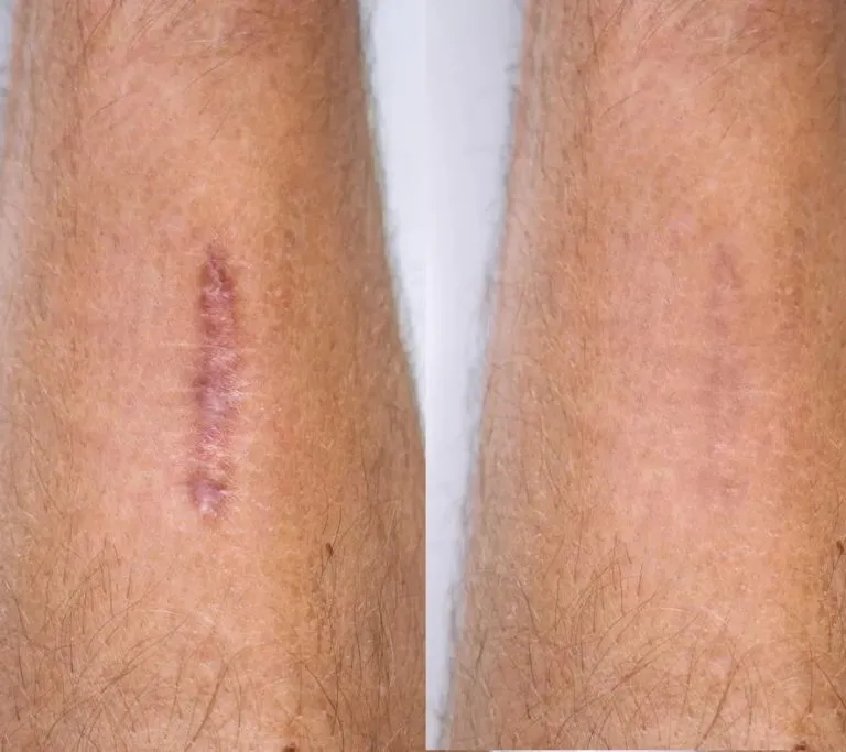 SCAR-STRETCH-MARK-CAMOUFLAGE3-copy-768x683