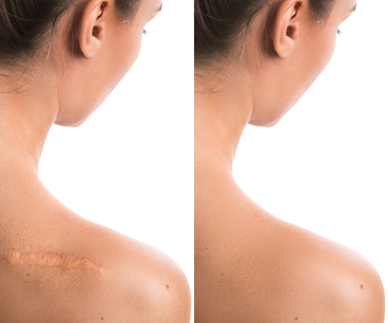 Scar-Camouflage-9-768x639