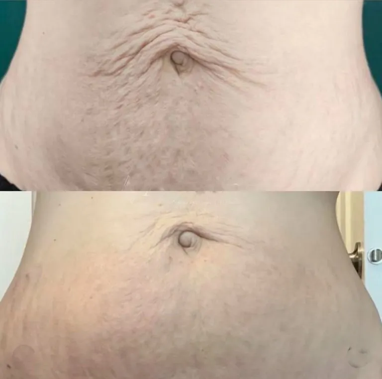 Scar-Stretch-Mark-Camouflage-15-768x762