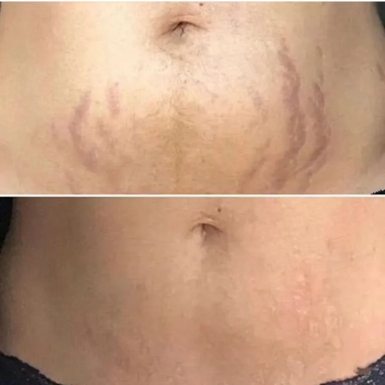 Scar-Stretch-Mark-Camouflage-16-768x768