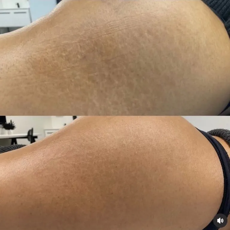 Scar-Stretch-Mark-Camouflage-17-768x767