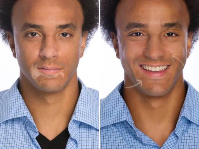 Scar-Stretch-Mark-Camouflage-18-768x574