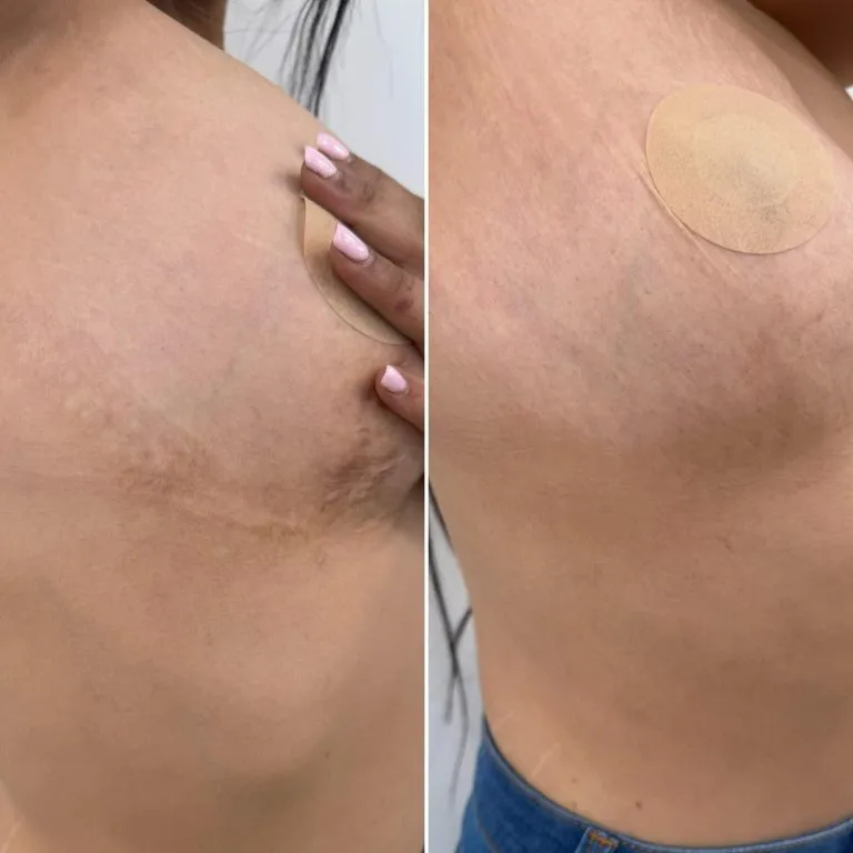 Scar-Stretch-Mark-Camouflage-2-768x768