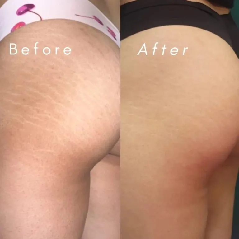 Scar-Stretch-Mark-Camouflage-21-768x768