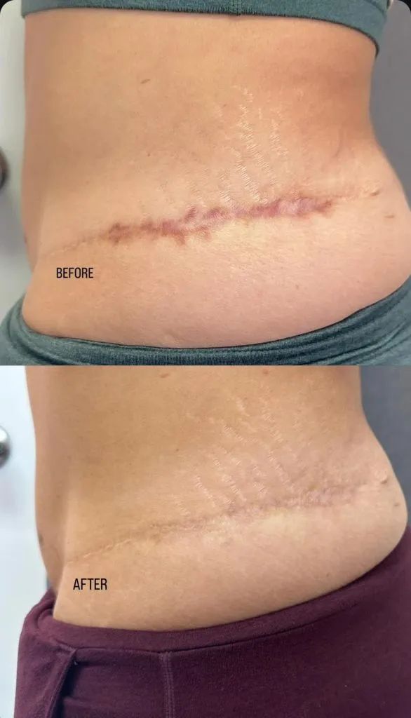 Scar-Stretch-Mark-Camouflage-In-NY-And-NYC-1-586x1024