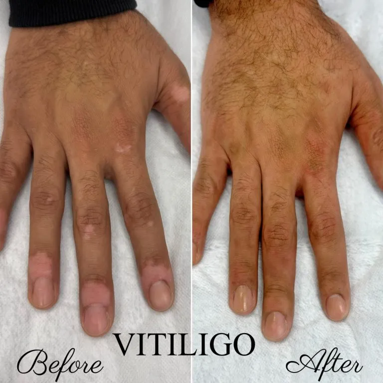 Scar-Stretch-Mark-Camouflage-In-NY-And-NYC-11-768x768