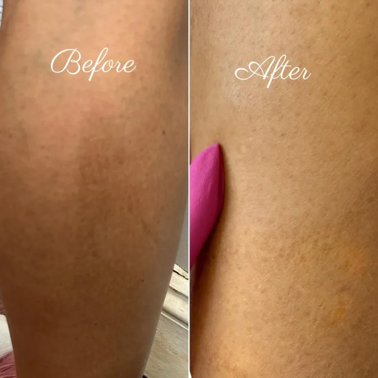 Scar-Stretch-Mark-Camouflage-In-NY-And-NYC-12-768x768