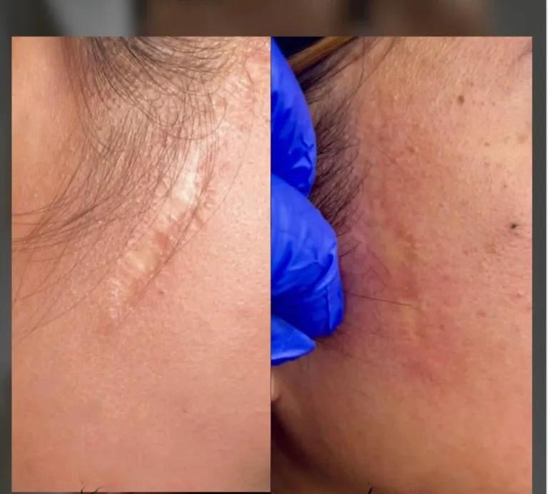 Scar-Stretch-Mark-Camouflage-In-NY-And-NYC-2-768x692