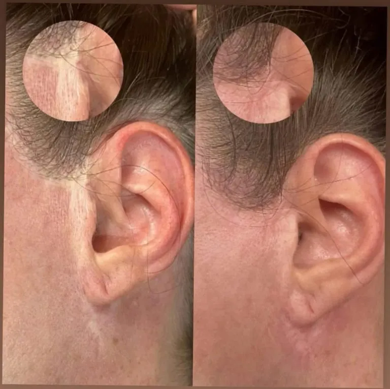 Scar-Stretch-Mark-Camouflage-In-NY-And-NYC-5-768x765