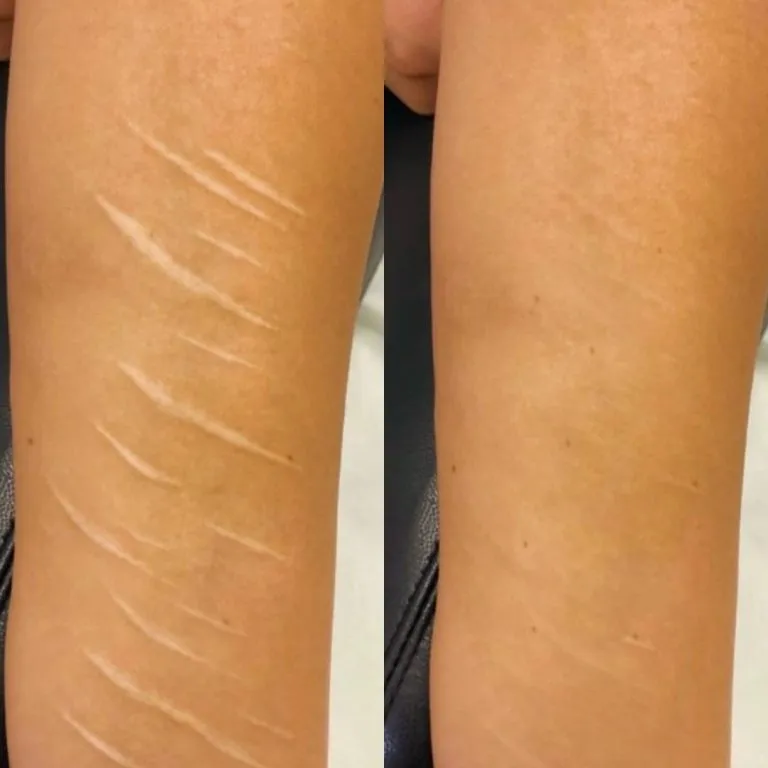 Scar-Stretch-Mark-Camouflage-In-NY-And-NYC-6-768x768