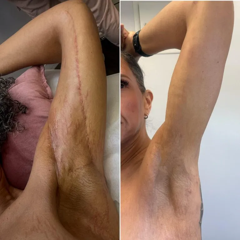 Scar-Stretch-Mark-Camouflage-In-NY-And-NYC-8-768x768