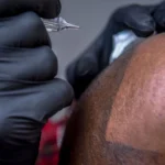 Scalp Micropigmentation