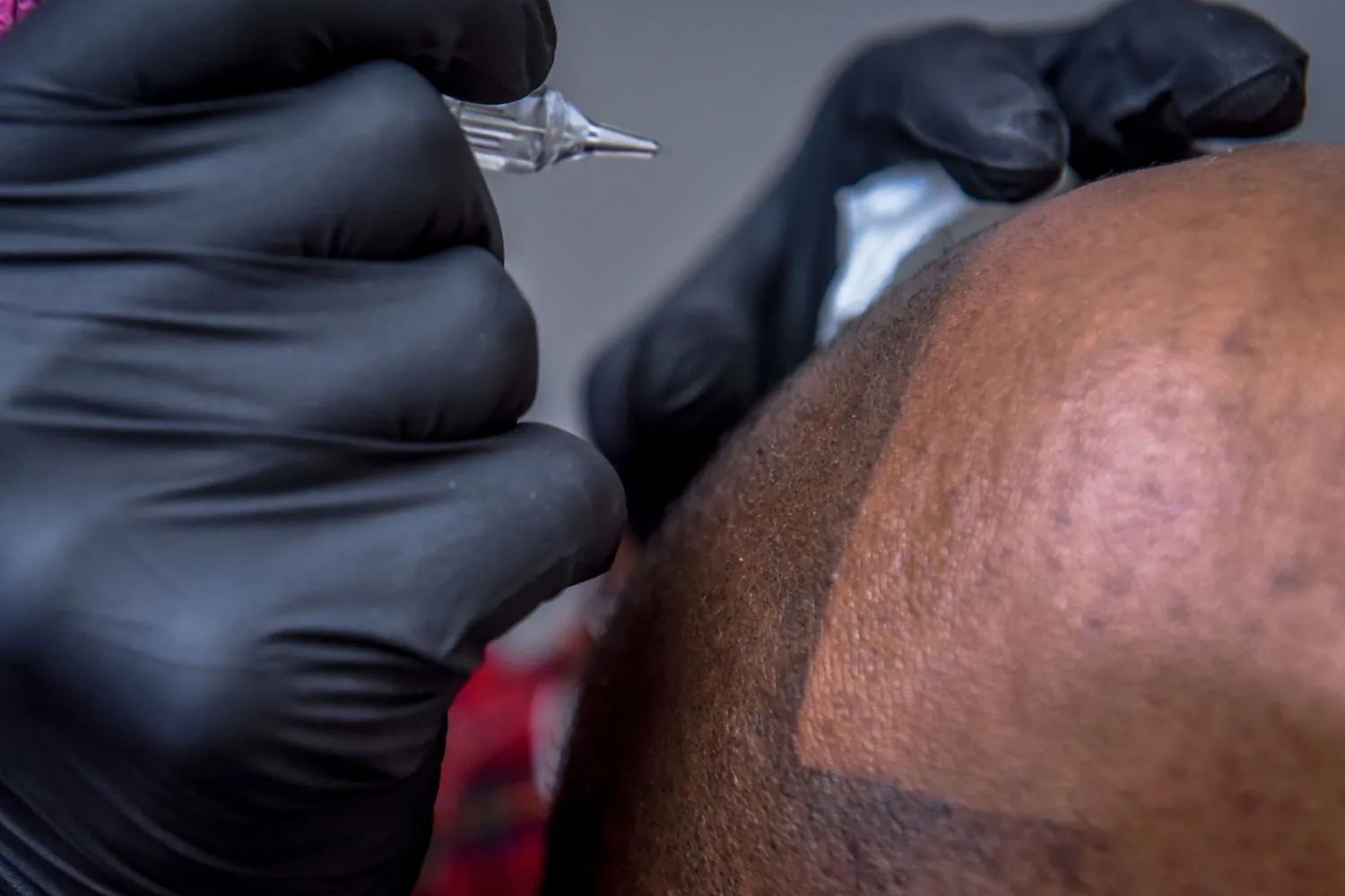Scalp Micropigmentation