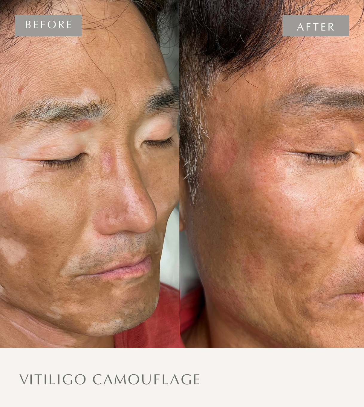 VITILIGO