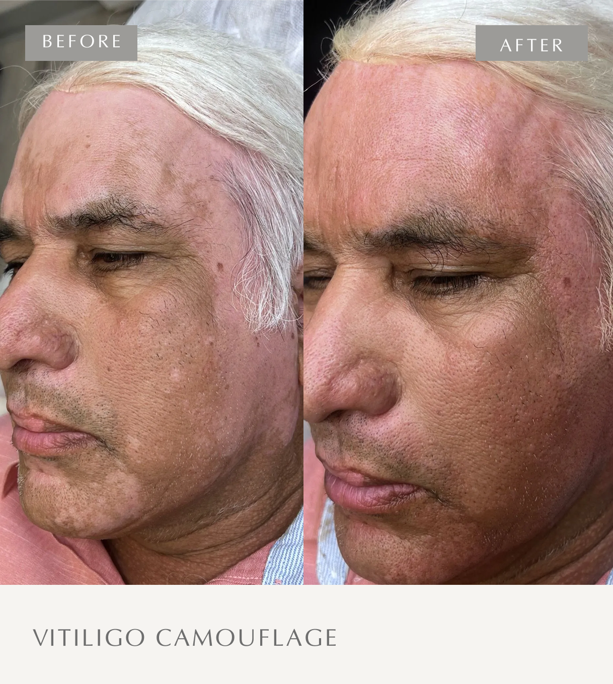 VITILIGO
