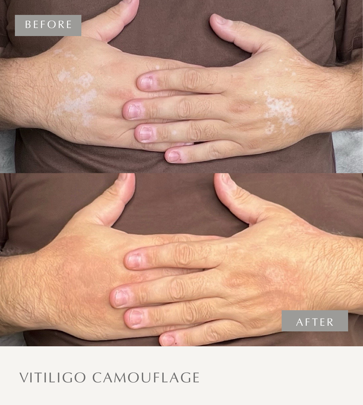 VITILIGO