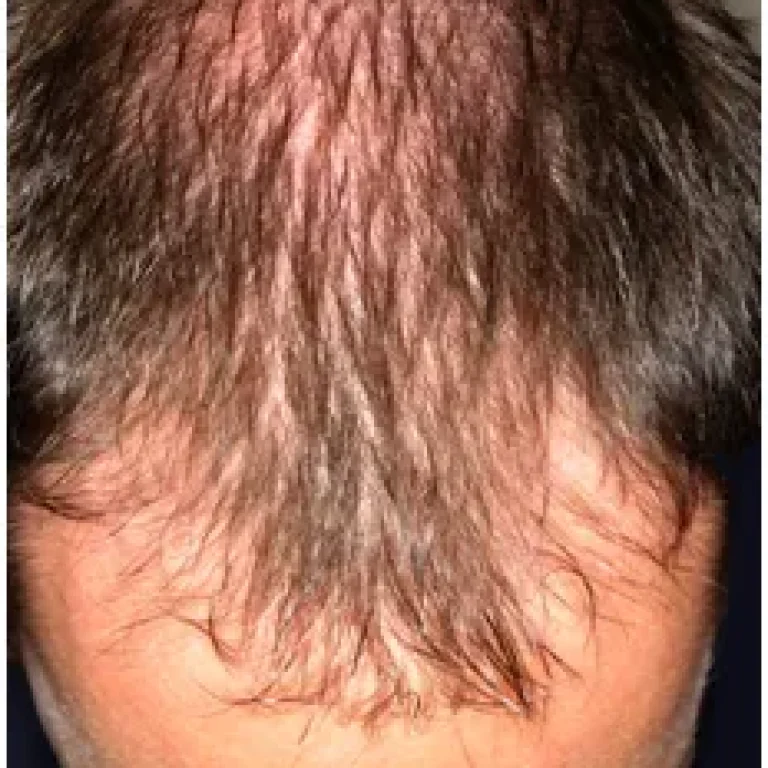 Hairloss-1