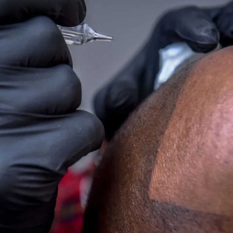 Scalp Micropigmentation